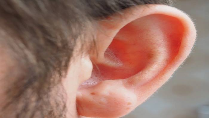 ศัลยกรรมใบหู สำหรับคนที่มีลักษณะหูกาง ไม่สมดุลกับใบหน้า